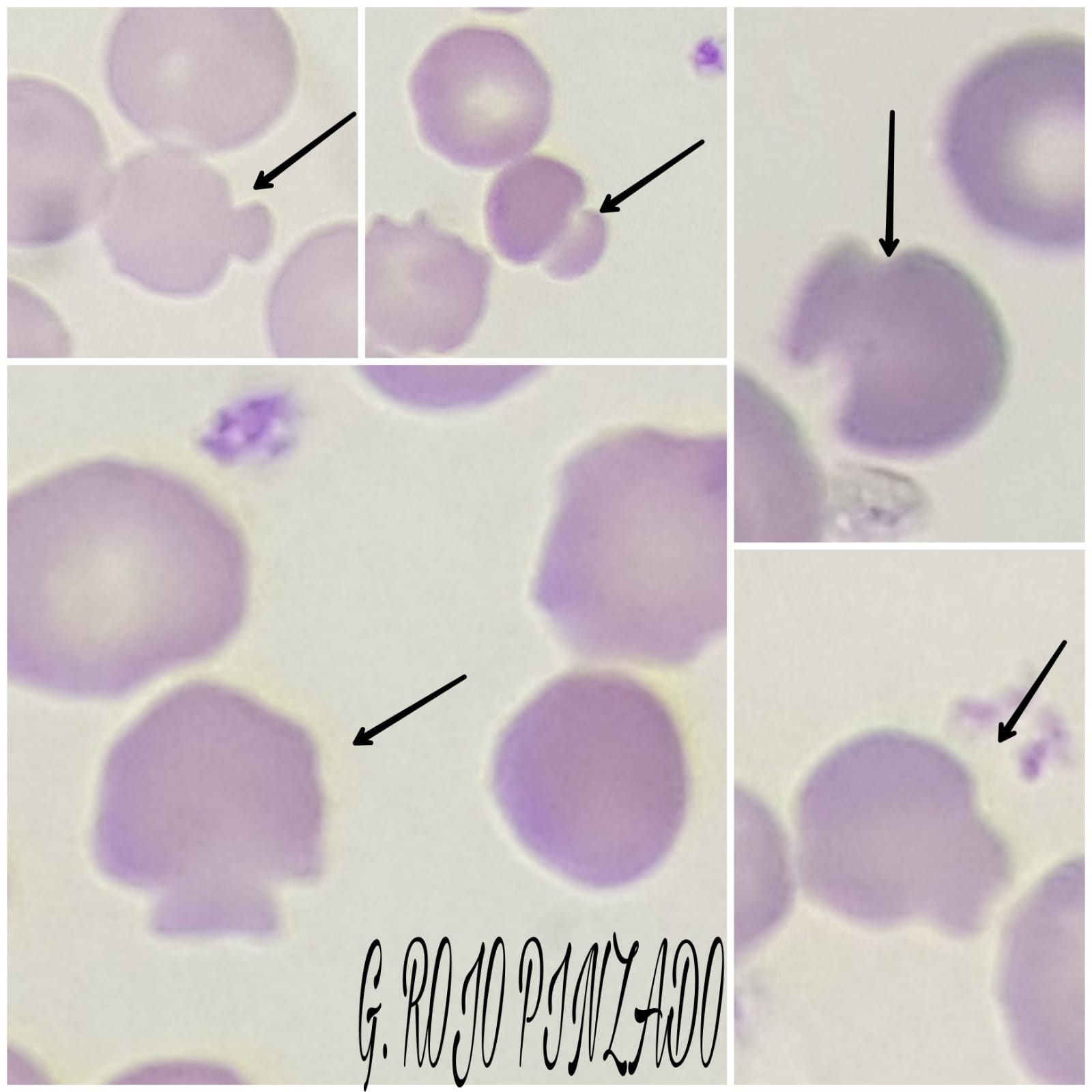 2021(02): Anemia microcítica y macrocítica