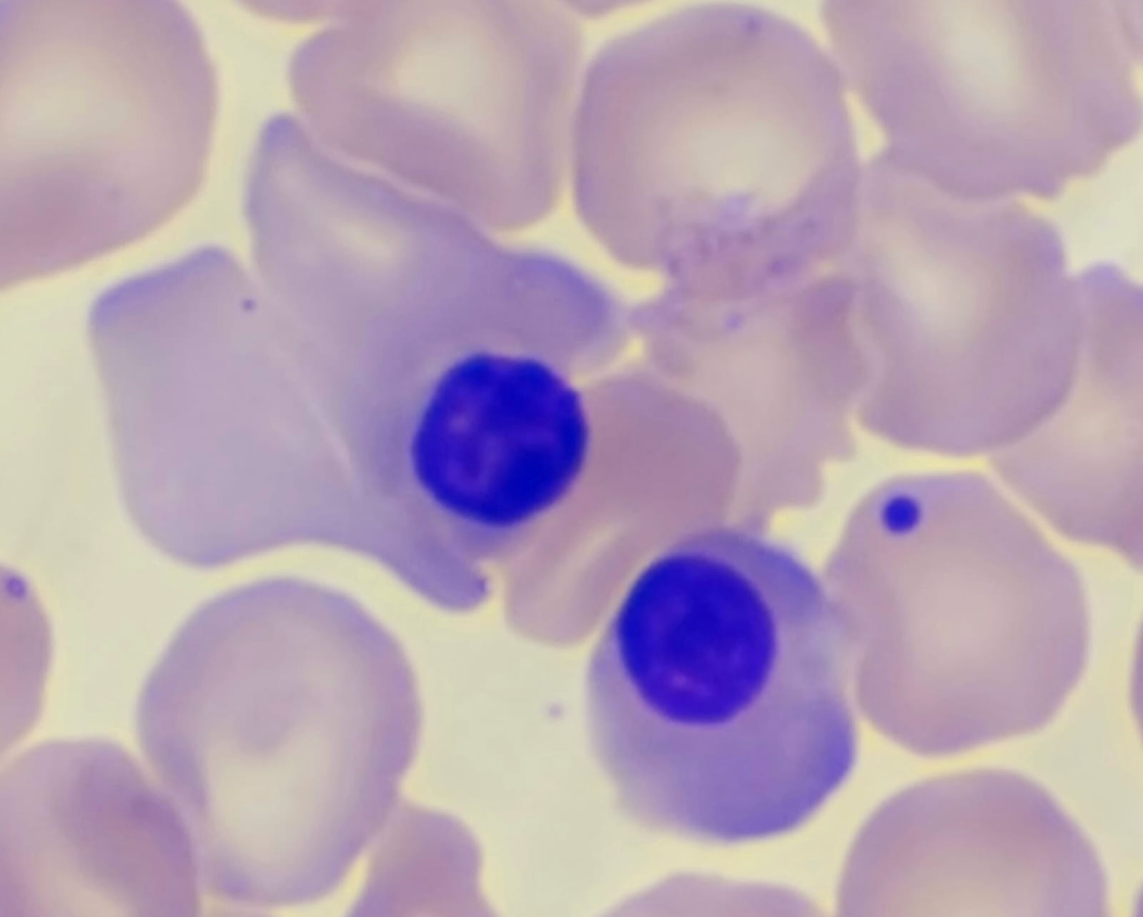 Magistral 2B - 2024 - Anemia macrocítica